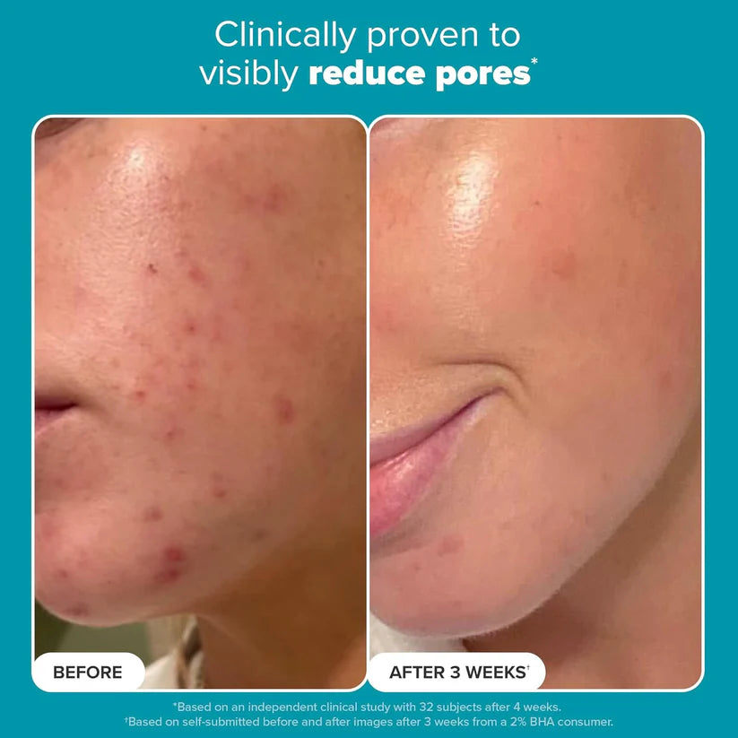 Paula's Choice 2% BHA Liquid Exfoliant with Salicylic Acid – Pore Minimizer & Blackhead Remover for Clear, Glowing Skin